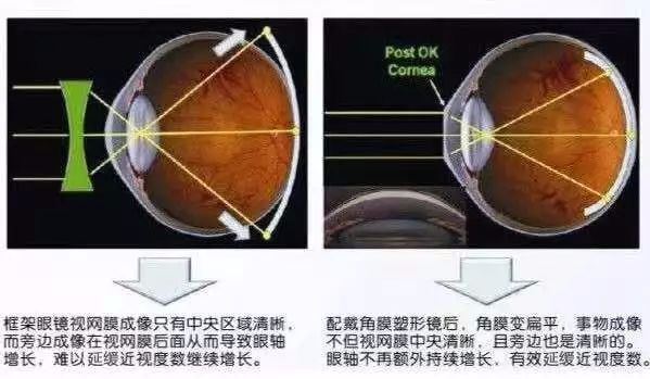 梦戴维角膜塑形镜价格散光,梦戴维角膜塑形镜价格散光与实效性策略解读,前沿解读说明_版职69.18.67