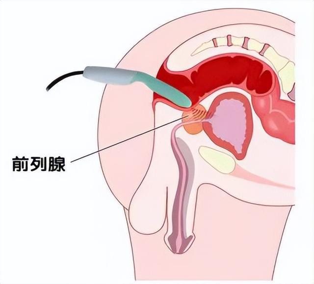 前列腺腺囊肿是怎么回事,前列腺腺囊肿是怎么回事？合理化决策评审解析_V91.50.91,实地数据分析方案_版国94.20.91