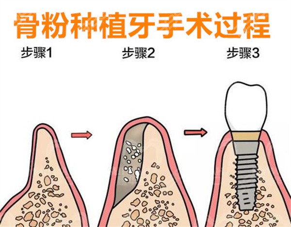 满口牙种植需要几颗植体,满口牙种植需要的植体数量及资源整合策略实施探讨——升级版方案96.27.45,重要性说明方法_镂版66.69.18