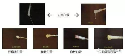 短裤上有黄色分泌物正常吗