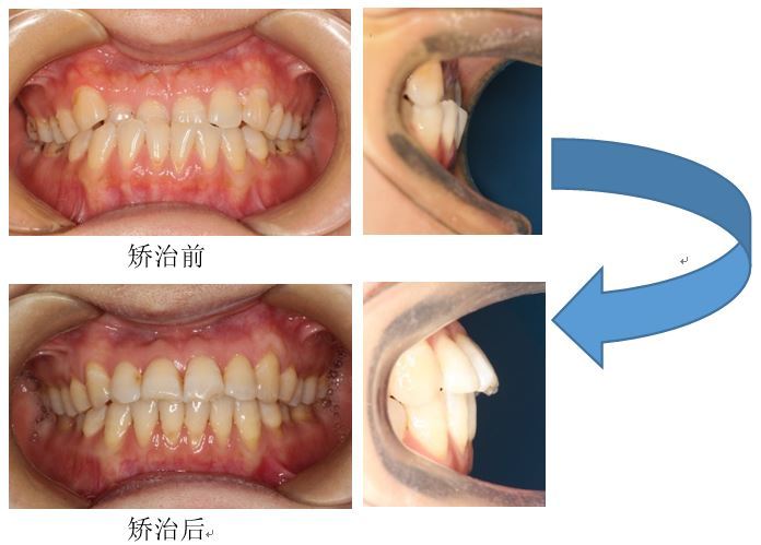 隐形正畸与传统正畸的优缺点