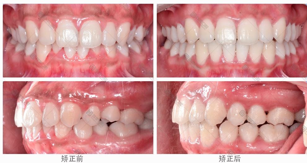 牙齿前突怎么矫正多少钱,牙齿前突矫正方法及费用解析，重要性、定义、解释与歌版指南,现象解答解释定义_升级版70.21.58