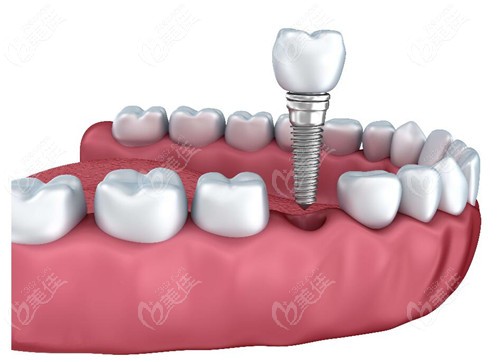 种植牙多少钱一颗呀哪里有